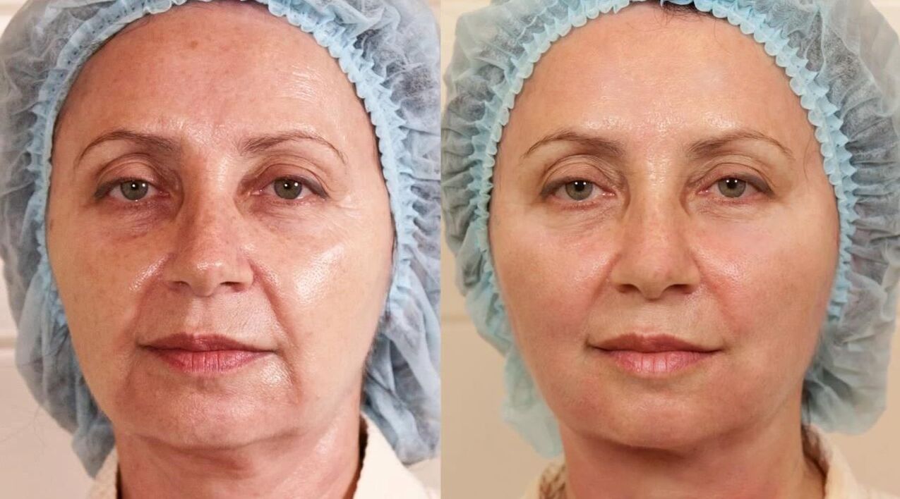 photos before and after a facelift