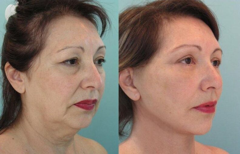 The result of rejuvenating the skin of the face by tightening it with threads. 