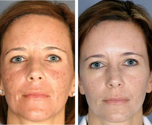 Before and after fractional facial thermolysis. 