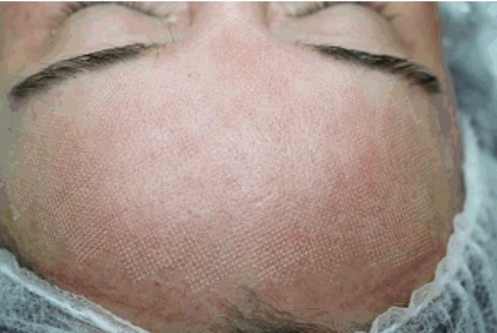 Redness and slight swelling of the skin after fractional laser. 