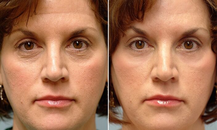 face before and after fractional laser resurfacing