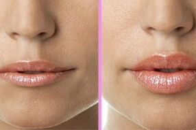 before and after the lip restoration procedure