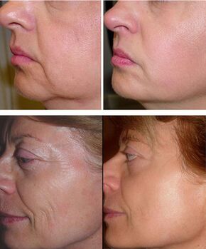 photo before and after fractional laser resurfacing